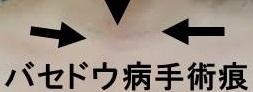 甲状腺手術後の瘢痕 甲状腺手術後の瘢痕
