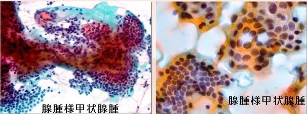 腺腫様結節 細胞診 腺腫様結節 細胞診