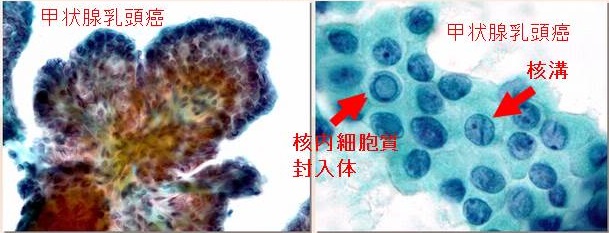 甲状腺乳頭癌の細胞診 甲状腺乳頭癌の細胞診