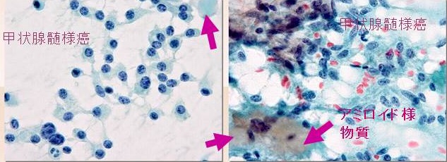 甲状腺髄様癌の細胞診所見 甲状腺髄様癌の細胞診所見