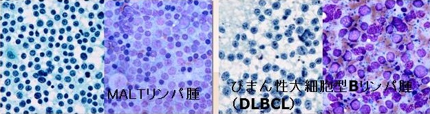 甲状腺原発悪性リンパ腫 細胞診 甲状腺原発悪性リンパ腫 細胞診