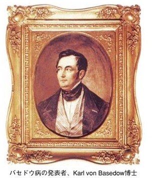 バセドウ病の発見者 バセドウ博士 バセドウ病の発見者 バセドウ博士