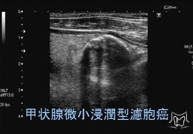 甲状腺微小浸潤型濾胞癌 超音波(エコー)画像 甲状腺微小浸潤型濾胞癌 超音波(エコー)画像