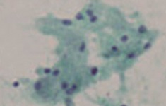 Granular cell tumor 細胞診 Granular cell tumor 細胞診