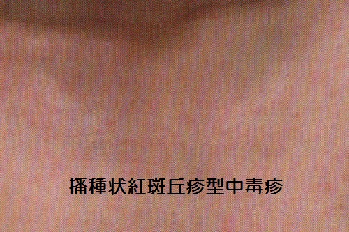 播種状紅斑丘疹型中毒疹 播種状紅斑丘疹型中毒疹