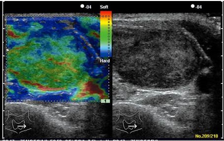 良性濾胞腺腫 エラストグラフィー2 良性濾胞腺腫 エラストグラフィー2