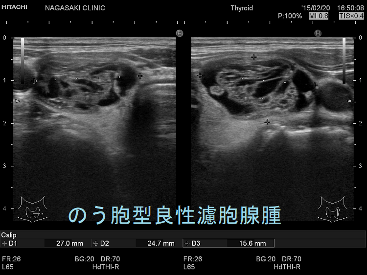 のう胞型良性濾胞腺腫 超音波(エコー)画像 のう胞型良性濾胞腺腫 超音波(エコー)画像