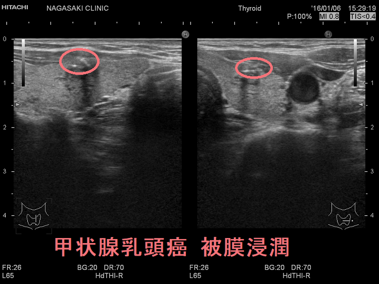 甲状腺乳頭癌 被膜浸潤 超音波(エコー)画像 甲状腺乳頭癌 被膜浸潤 超音波(エコー)画像