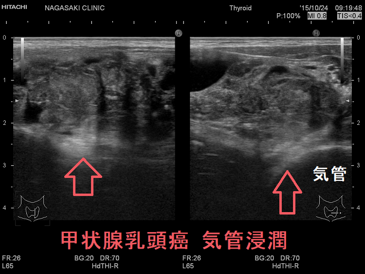 甲状腺乳頭癌 気管浸潤 超音波(エコー)画像 甲状腺乳頭癌 気管浸潤 超音波(エコー)画像