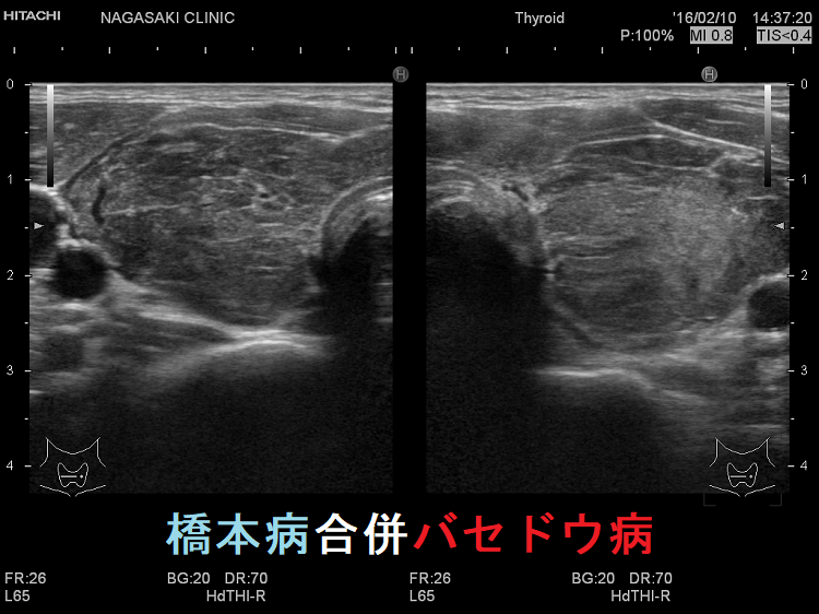 橋本病合併バセドウ病 超音波(エコー)画像 橋本病合併バセドウ病 超音波(エコー)画像