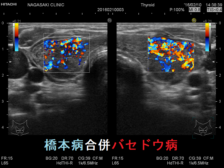 橋本病合併バセドウ病 超音波(エコー)像 ドプラー 橋本病合併バセドウ病 超音波(エコー)像 ドプラー