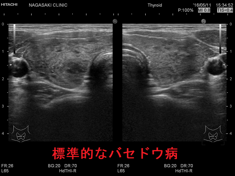 標準的なバセドウ病 超音波(エコー)画像 標準的なバセドウ病 超音波(エコー)画像