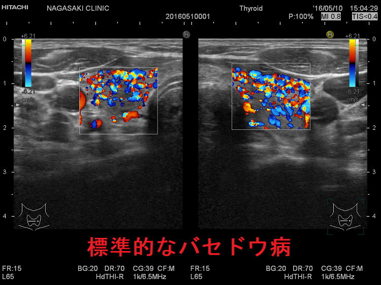 標準的なバセドウ病 超音波(エコー)画像 ドプラー 標準的なバセドウ病 超音波(エコー)画像 ドプラー