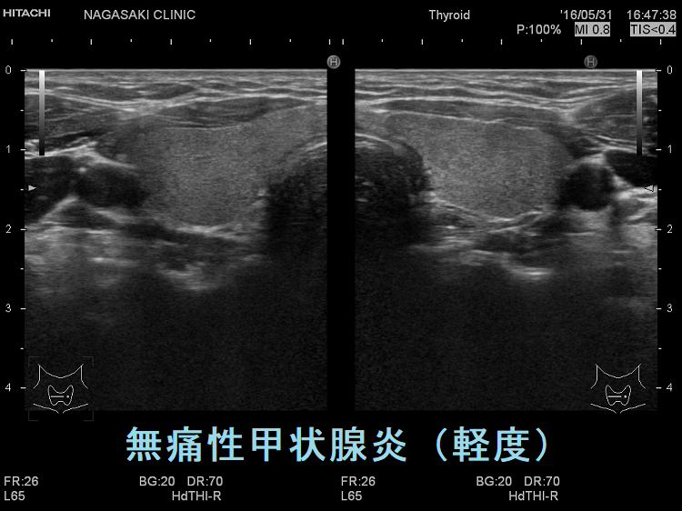 無痛性甲状腺炎(軽度) 超音波(エコー)画像 無痛性甲状腺炎(軽度) 超音波(エコー)画像