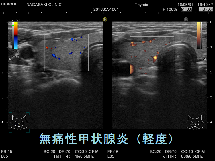 無痛性甲状腺炎(軽度) 超音波(エコー)画像 ドプラーモード 無痛性甲状腺炎(軽度) 超音波(エコー)画像 ドプラーモード