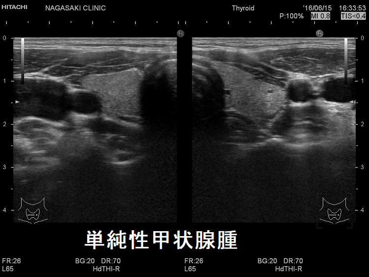 単純性甲状腺腫 超音波(エコー)画像 単純性甲状腺腫 超音波(エコー)画像