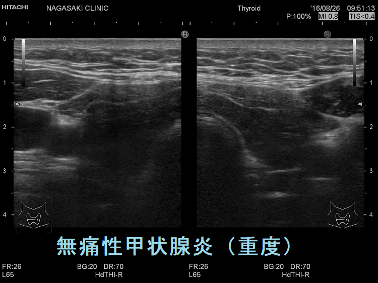 無痛性甲状腺炎(重度)超音波画像 無痛性甲状腺炎(重度)超音波画像