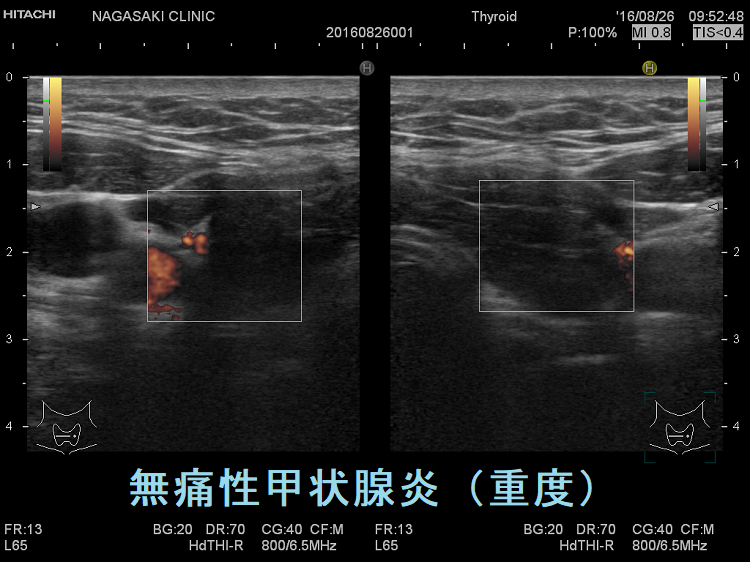 無痛性甲状腺炎(重度)ドプラーモード 無痛性甲状腺炎(重度)ドプラーモード
