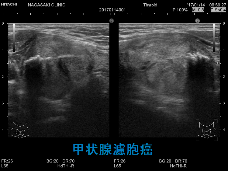 甲状腺濾胞癌 超音波(エコー)画像 甲状腺濾胞癌 超音波(エコー)画像