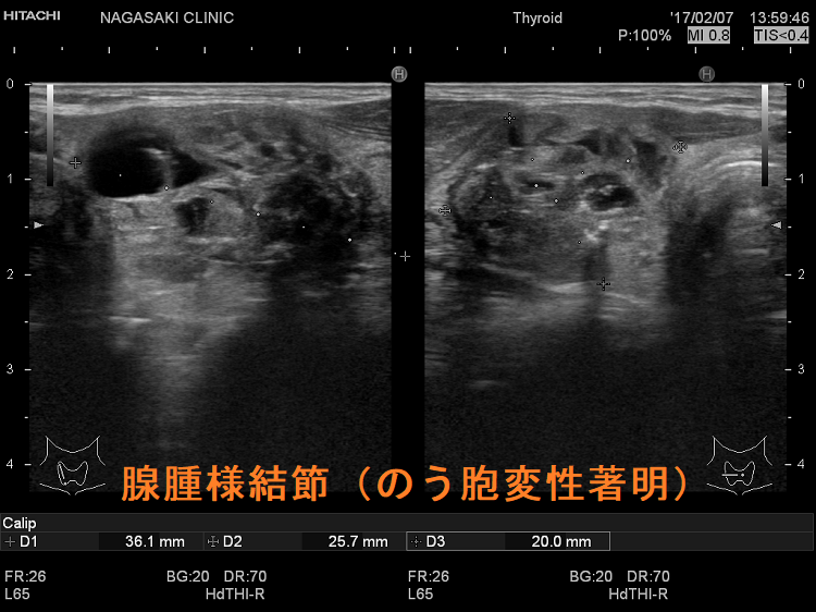 腺腫様結節(のう胞変性著明)超音波(エコー)画像 腺腫様結節(のう胞変性著明)超音波(エコー)画像