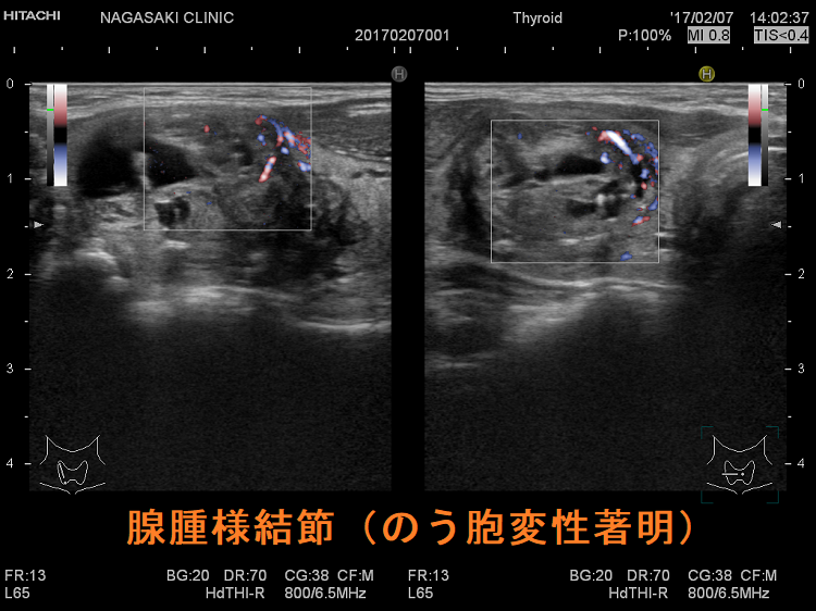 腺腫様結節(のう胞変性著明)ドプラーモード 腺腫様結節(のう胞変性著明)ドプラーモード