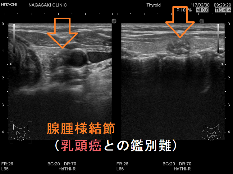超音波(エコー)検査での腺腫様甲状腺腫・腺腫様結節と甲状腺乳頭