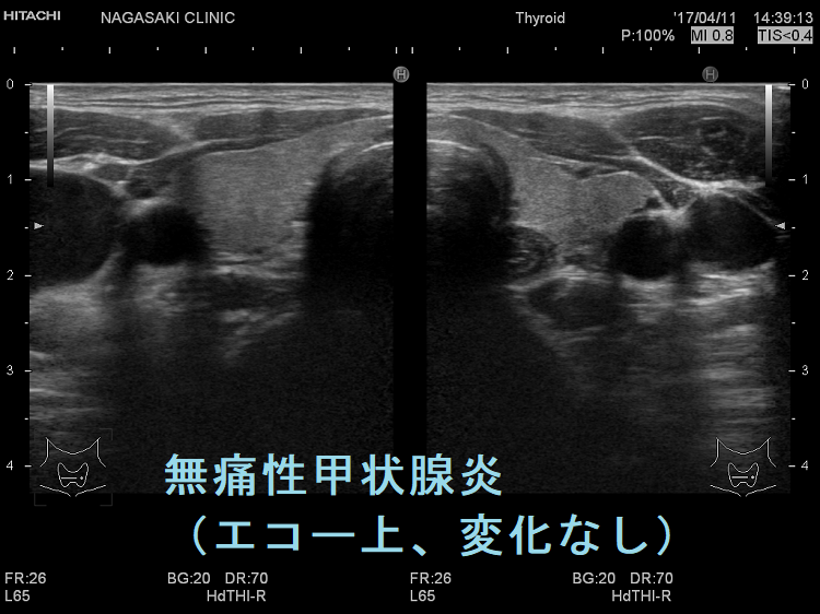 無痛性甲状腺炎(エコー上、変化なし) 無痛性甲状腺炎(エコー上、変化なし)