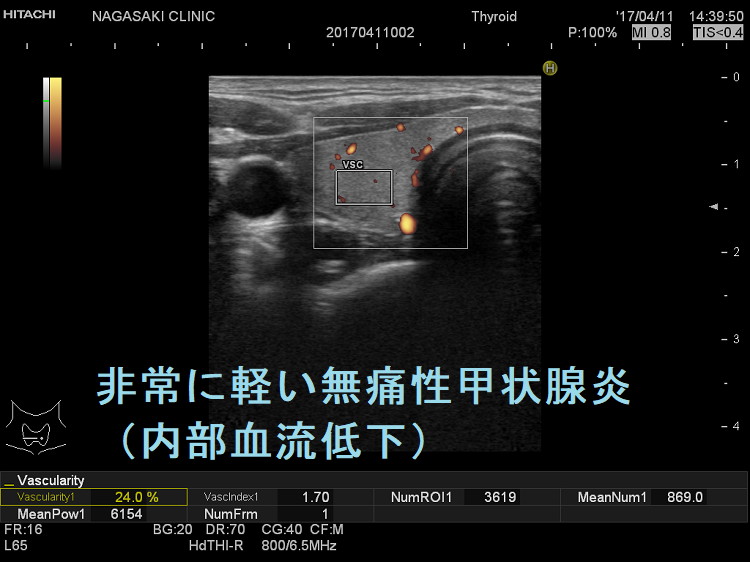 非常に軽い無痛性甲状腺炎(内部血流低下) 非常に軽い無痛性甲状腺炎(内部血流低下)