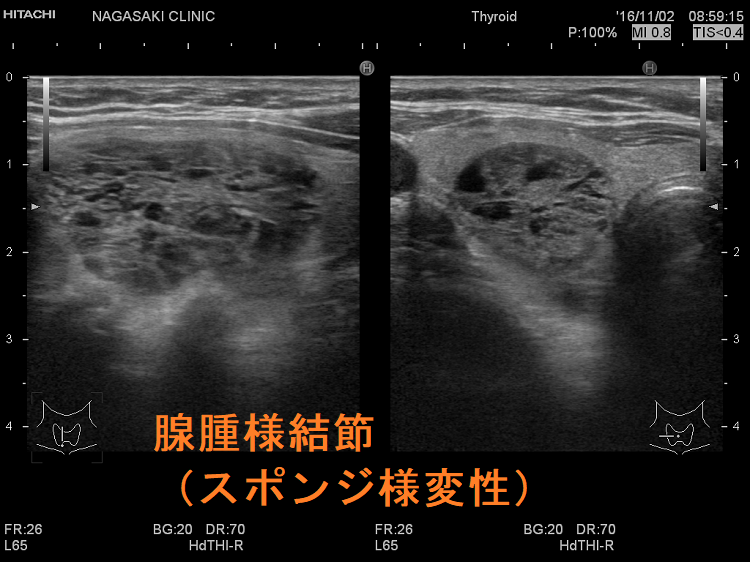 腺腫様結節(スポンジ様変性) 腺腫様結節(スポンジ様変性)