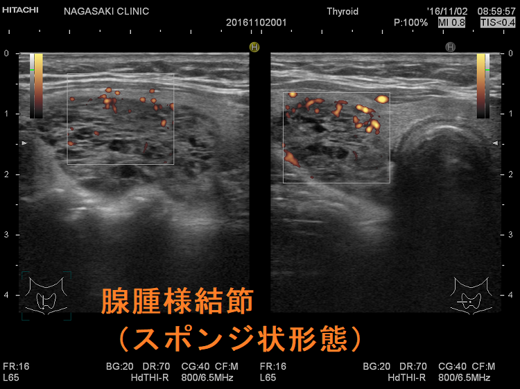 腺腫様結節(スポンジ状形態)ドプラーモード 腺腫様結節(スポンジ状形態)ドプラーモード