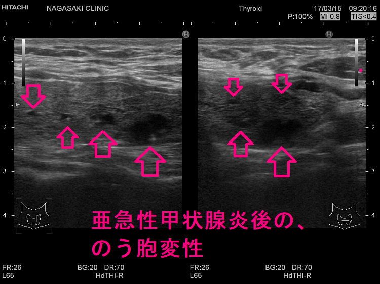 亜急性甲状腺炎後の、のう胞変性 亜急性甲状腺炎後の、のう胞変性