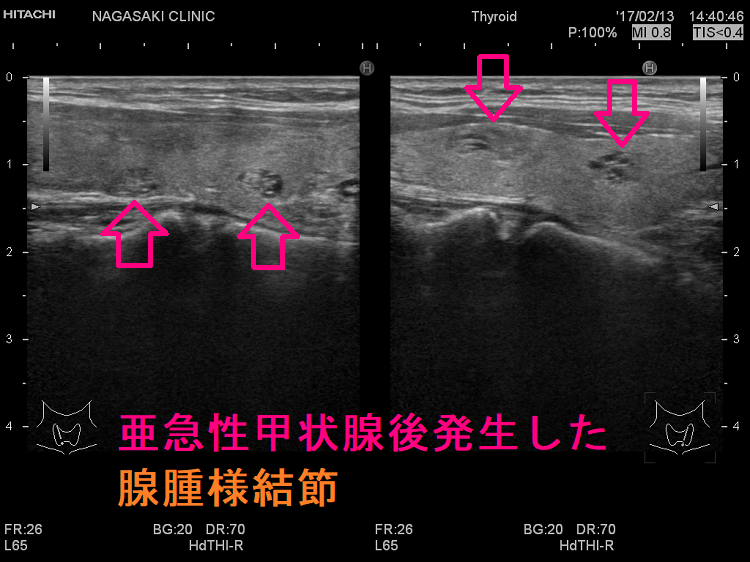 亜急性甲状腺後発生した腺腫様結節 亜急性甲状腺後発生した腺腫様結節