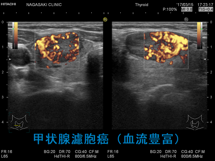 甲状腺濾胞癌(血流豊富)超音波(エコー)画像 甲状腺濾胞癌(血流豊富)超音波(エコー)画像2
