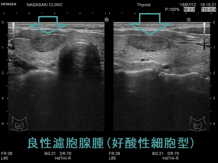 良性濾胞腺腫(好酸性細胞型)超音波画像 良性濾胞腺腫(好酸性細胞型)超音波画像