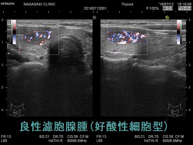良性濾胞腺腫(好酸性細胞型)ドプラー 良性濾胞腺腫(好酸性細胞型)ドプラー