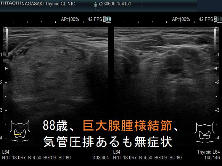 88歳、巨大腺腫様結節、気管圧排あるも無症状2 88歳、巨大腺腫様結節、気管圧排あるも無症状2
