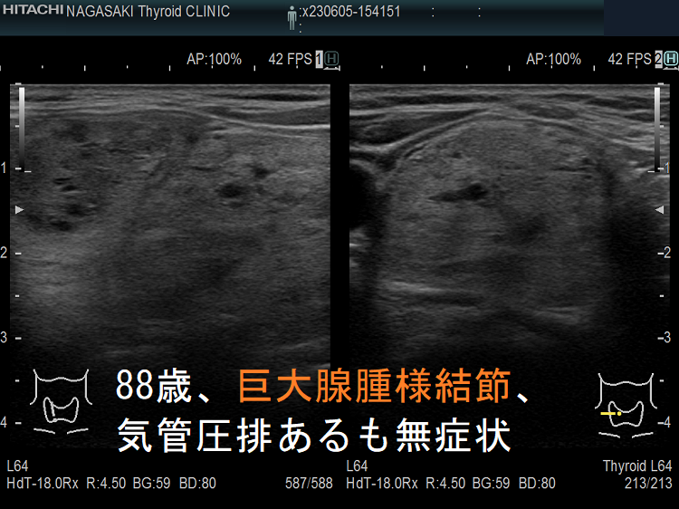 88歳、巨大腺腫様結節、気管圧排あるも無症状2 88歳、巨大腺腫様結節、気管圧排あるも無症状