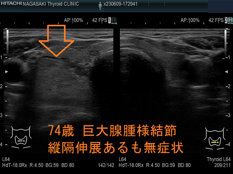 74歳 巨大腺腫様結節 縦隔伸展あるも無症状 74歳 巨大腺腫様結節 縦隔伸展あるも無症状