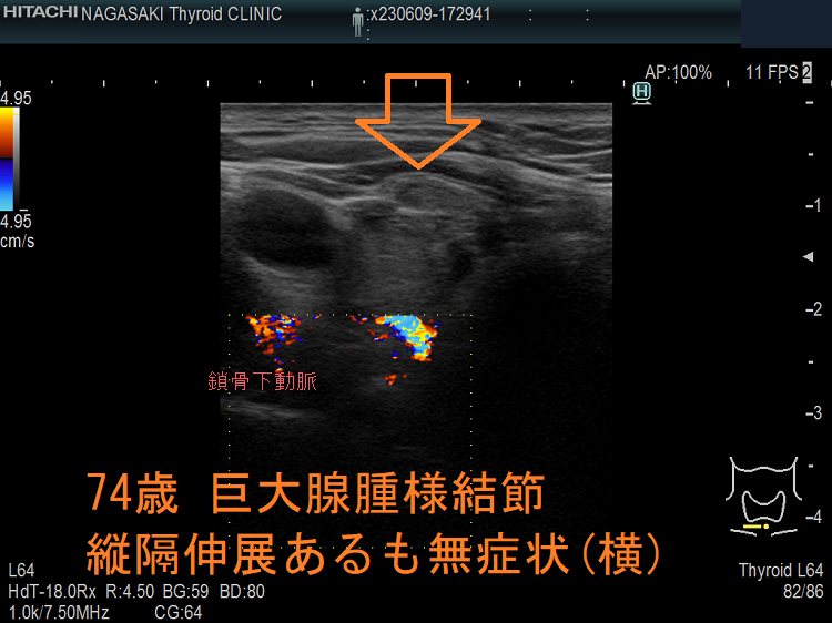 74歳 巨大腺腫様結節 縦隔伸展あるも無症状(横) 74歳 巨大腺腫様結節 縦隔伸展あるも無症状(横)