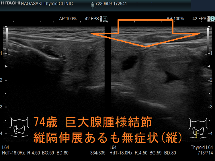 74歳 巨大腺腫様結節 縦隔伸展あるも無症状(縦) 74歳 巨大腺腫様結節 縦隔伸展あるも無症状(縦)