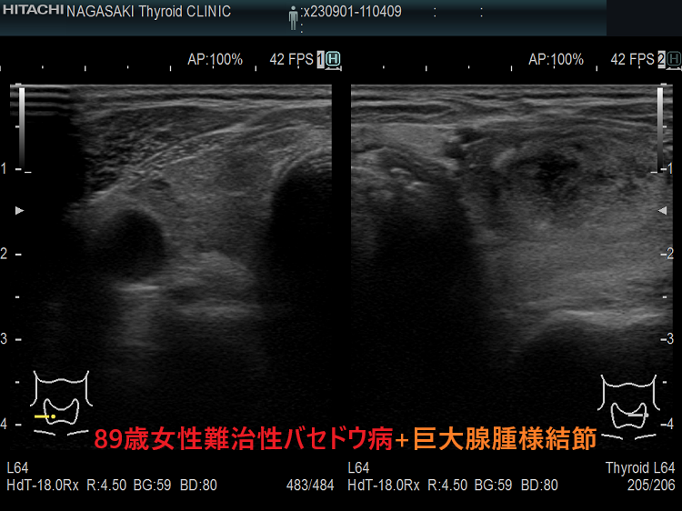 89歳女性 難治性バセドウ病+巨大腺腫様結節2 89歳女性 難治性バセドウ病+巨大腺腫様結節2