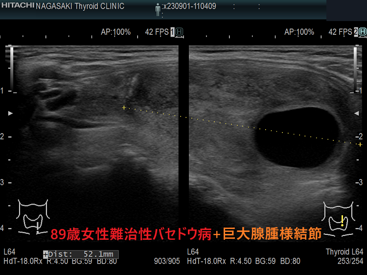 89歳女性 難治性バセドウ病+巨大腺腫様結節(垂直断) 89歳女性 難治性バセドウ病+巨大腺腫様結節(垂直断)