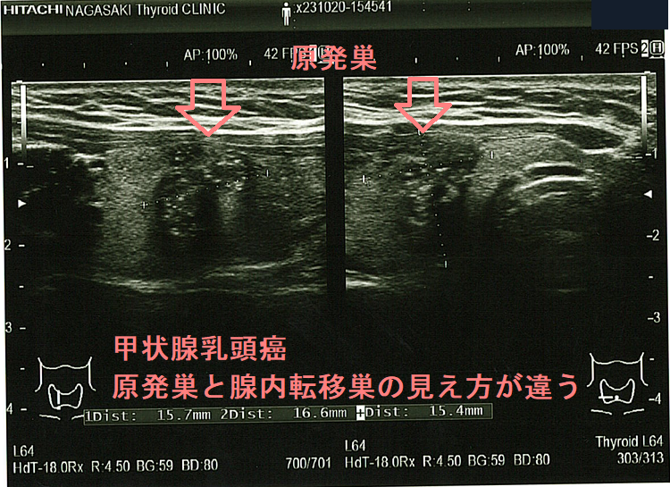 甲状腺乳頭癌 原発巣と腺内転移巣の見え方が違う 原発巣 甲状腺乳頭癌 原発巣と腺内転移巣の見え方が違う 原発巣