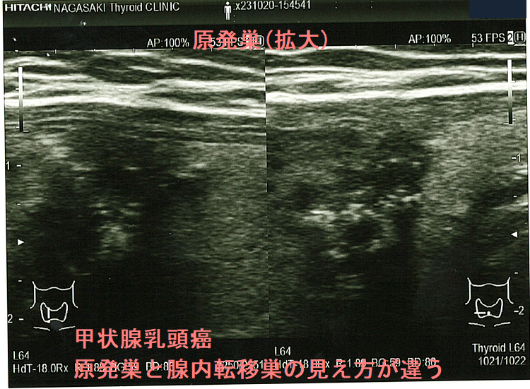 甲状腺乳頭癌 原発巣と腺内転移巣の見え方が違う 原発巣(拡大) 甲状腺乳頭癌 原発巣と腺内転移巣の見え方が違う 原発巣(拡大)