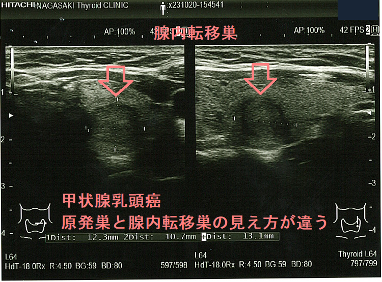甲状腺乳頭癌 原発巣と腺内転移巣の見え方が違う 腺内転移巣 甲状腺乳頭癌 原発巣と腺内転移巣の見え方が違う 腺内転移巣