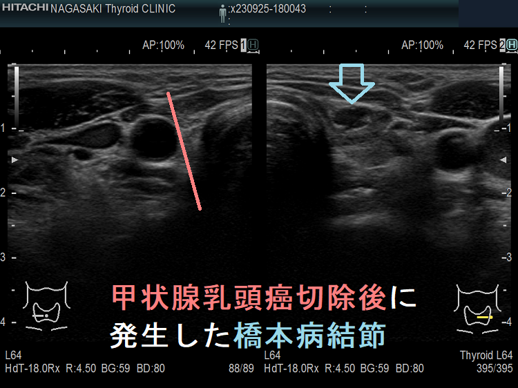 甲状腺乳頭癌切除後に発生した橋本病結節 甲状腺乳頭癌切除後に発生した橋本病結節