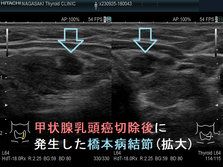 甲状腺乳頭癌切除後に発生した橋本病結節(拡大) 甲状腺乳頭癌切除後に発生した橋本病結節(拡大)