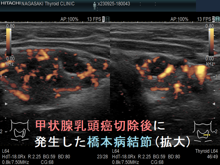 甲状腺乳頭癌切除後に発生した橋本病結節(拡大)ドプラーモード 甲状腺乳頭癌切除後に発生した橋本病結節(拡大)ドプラーモード