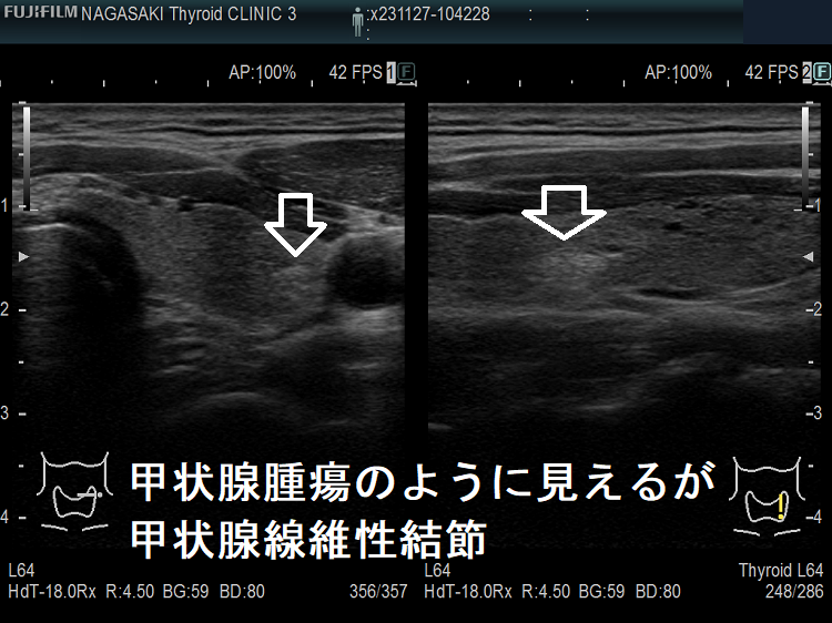 甲状腺腫瘍のように見えるが甲状腺線維性結節 甲状腺腫瘍のように見えるが甲状腺線維性結節