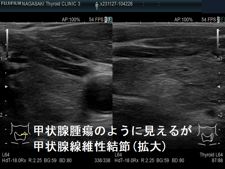 甲状腺腫瘍のように見えるが甲状腺線維性結節(拡大) 甲状腺腫瘍のように見えるが甲状腺線維性結節(拡大)
